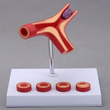 Модел сърдечно-съдова атеросклероза лице модел на тромбоза на кръвоносните съдове на човека на Медицински учебни пособия